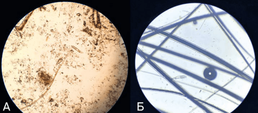 Рис. 1. Микрофото. Клещ Demodex canis: А — яйцо и имаго клеща; Б — имаго клеща Microphoto. Mite Demodex canis : egg&imago (A) and imago (B) of the mite